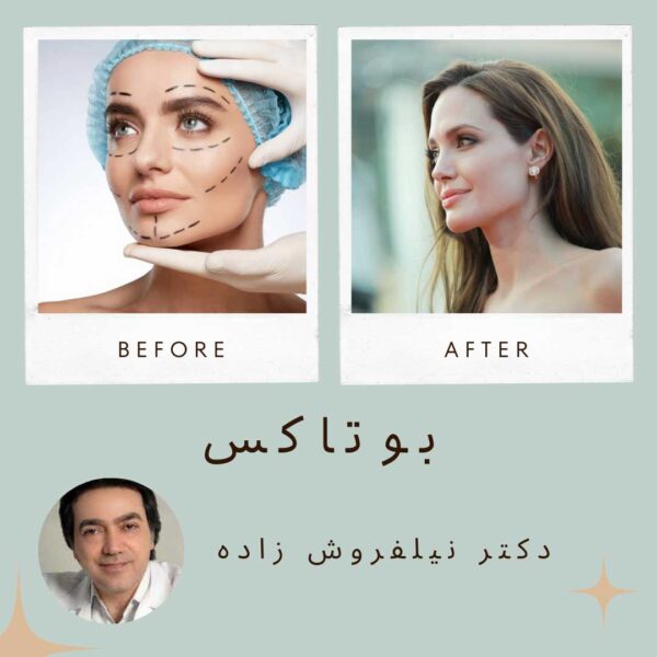 نمونه کارهای قبل و بعد بوتاکس دکتر نیلفروش زاده